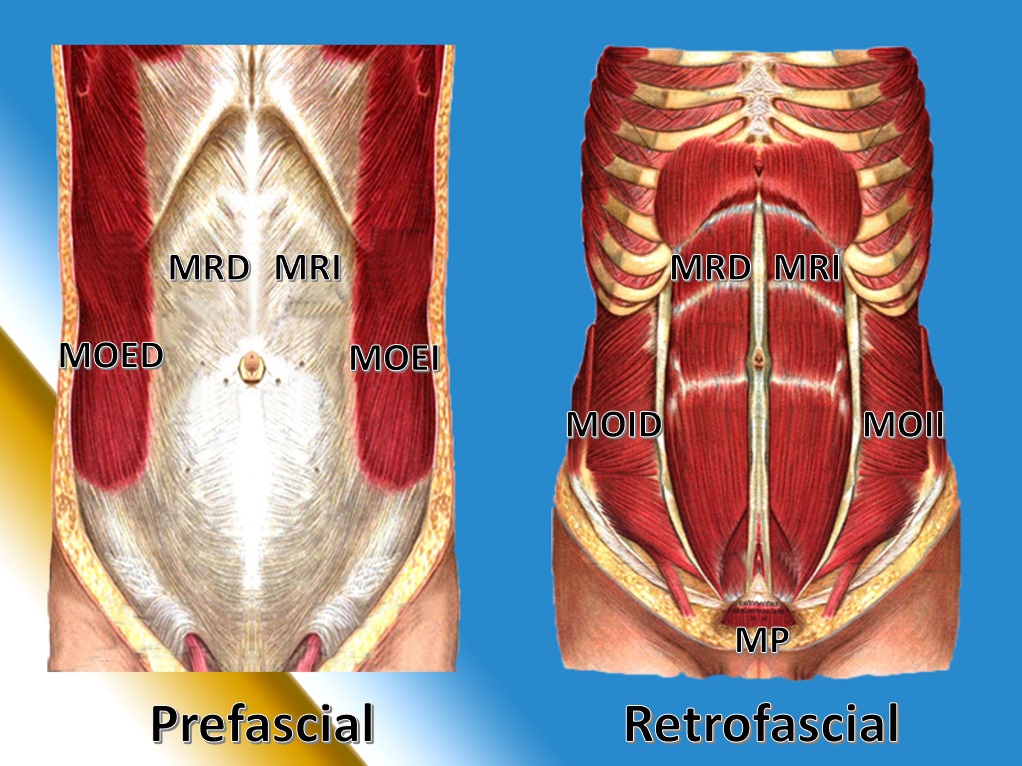 Anatomía De La Pared Abdominal Sin Diástasis Abdominal