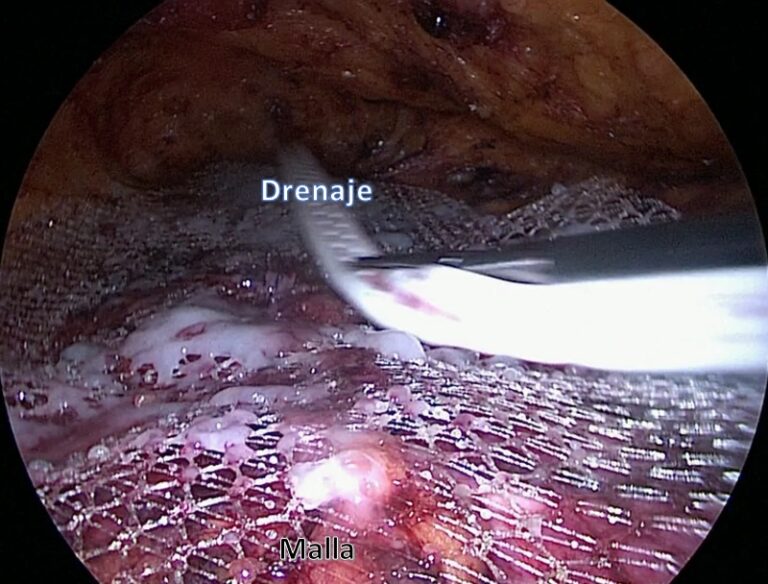 El temido seroma: qué es y cómo evitarlo. Primera parte – Sin Diástasis